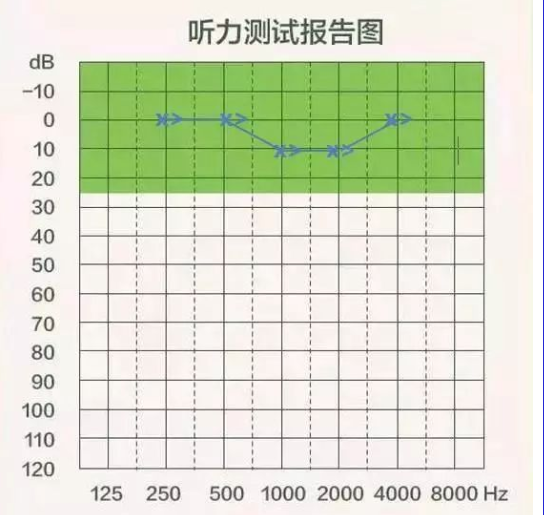 【听力科普】三分钟看懂纯音听力图(图10)