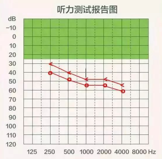 【听力科普】三分钟看懂纯音听力图(图12)